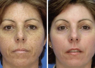Micro Laser Peel
