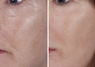 Nano Laser Peel
